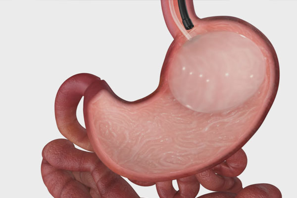 Mide Balonu Çeşitleri Nelerdir?